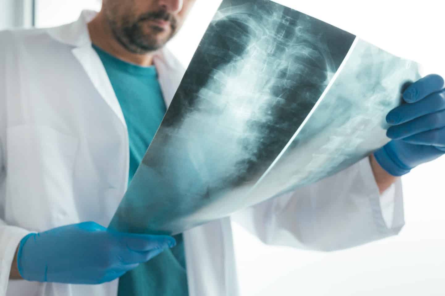 Spinal Cord Injury and Paralysis Cases
